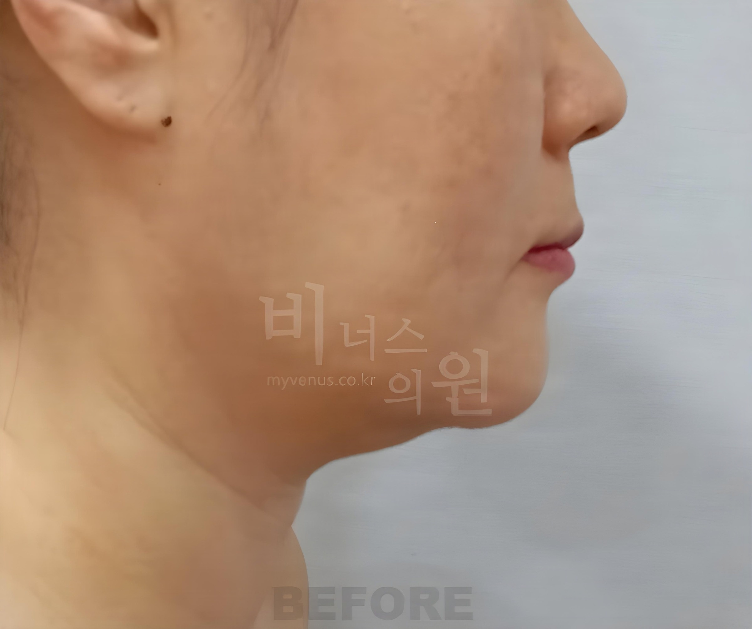 턱·이중턱 지방흡입 수술 전 오른쪽 측면 사진 (부천 비너스의원)