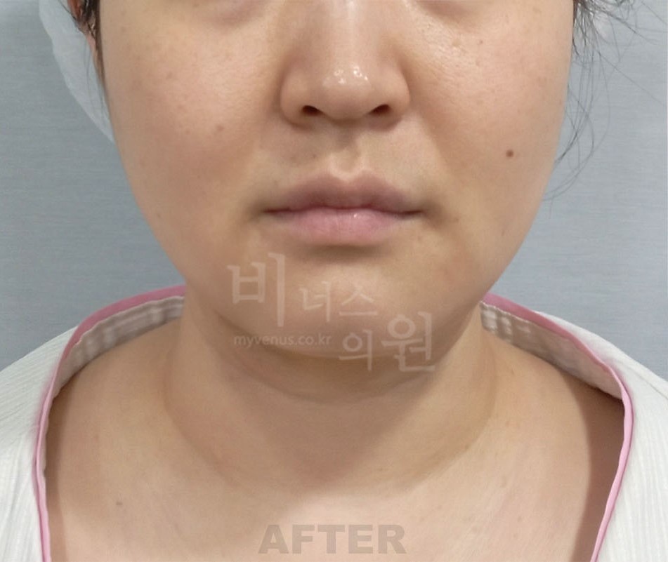 얼굴 하부 전후사진 수술 후 정면 (2025년 촬영, 부천 비너스의원)