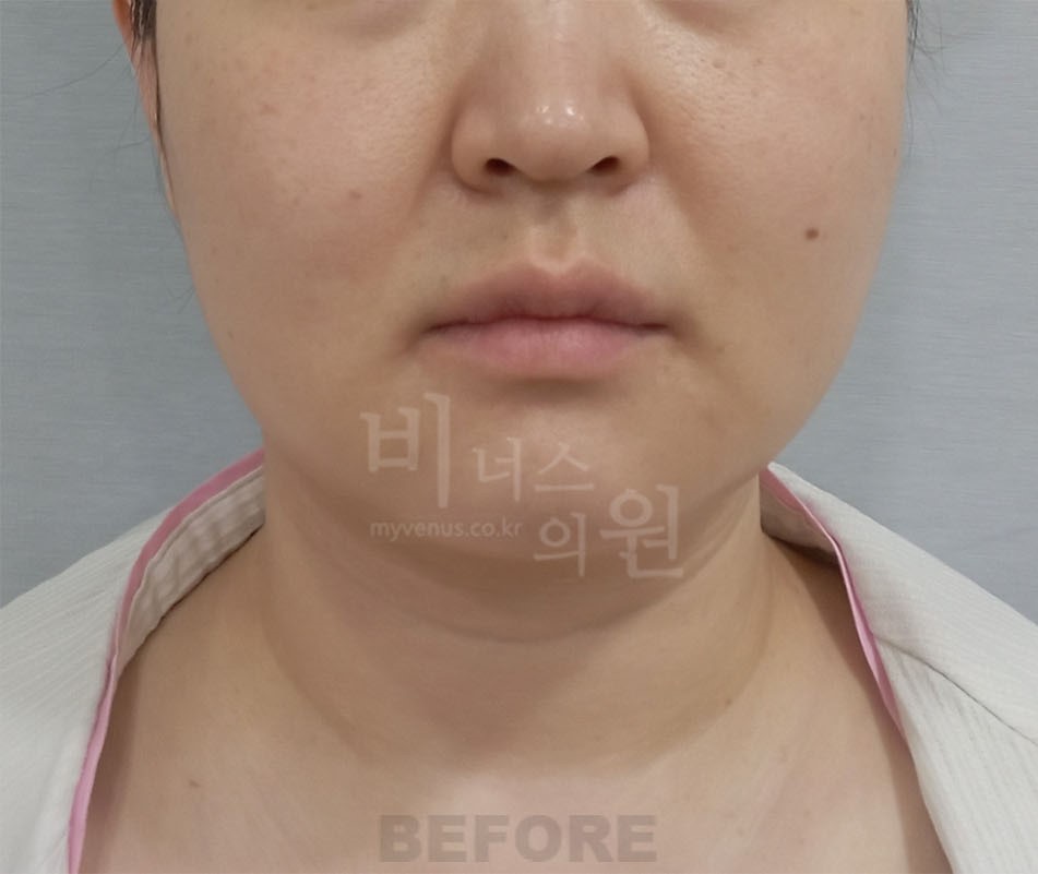 얼굴 하부 전후사진 수술 전 정면 (2025년 촬영, 부천 비너스의원)