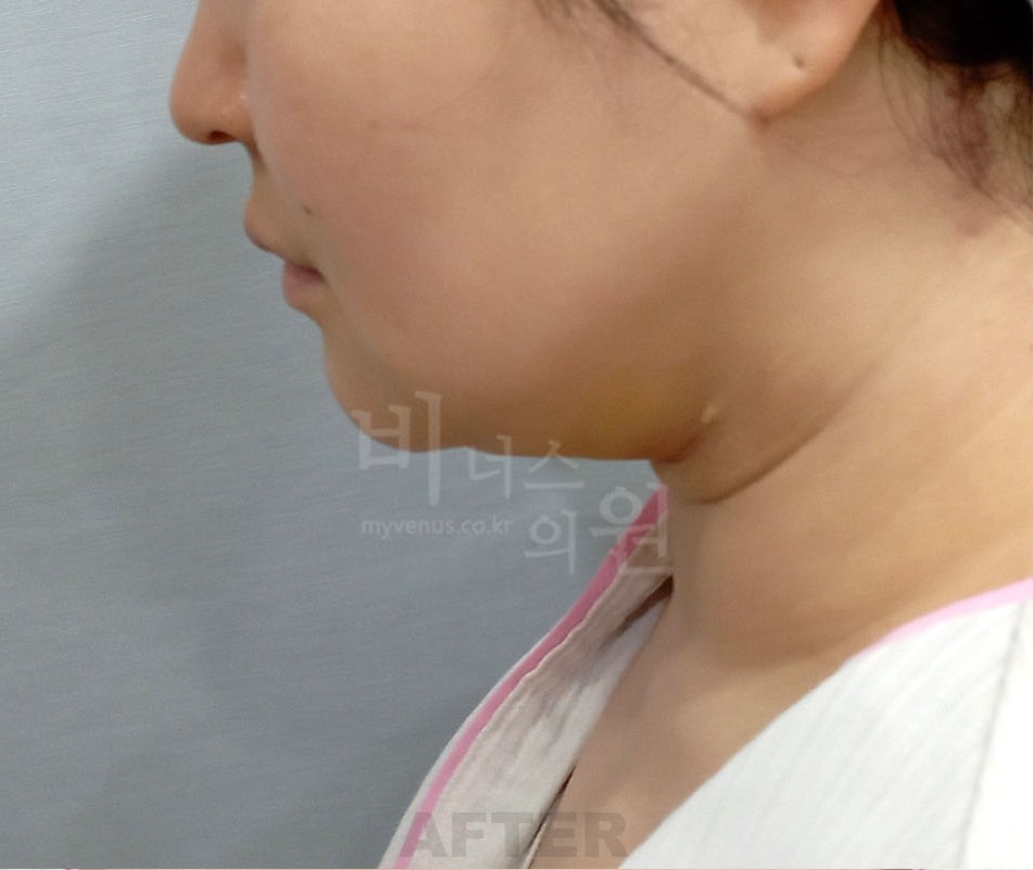 얼굴 하부 전후사진 수술 후 측면, 화면 왼쪽을 향함 (2025년 촬영, 부천 비너스의원)