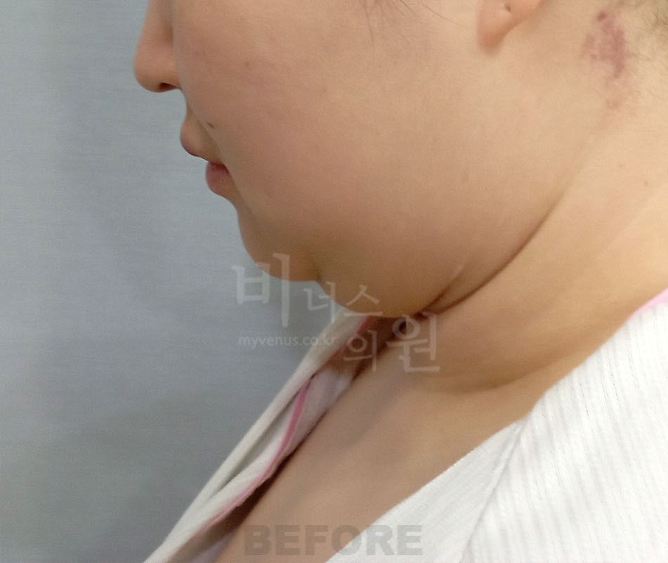 얼굴 하부 전후사진 수술 전 측면, 화면 왼쪽을 향함 (2025년 촬영, 부천 비너스의원)
