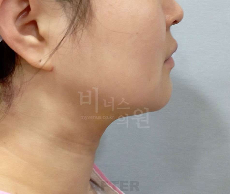 얼굴 하부 전후사진 수술 후 측면, 화면 오른쪽을 향함 (2025년 촬영, 부천 비너스의원)