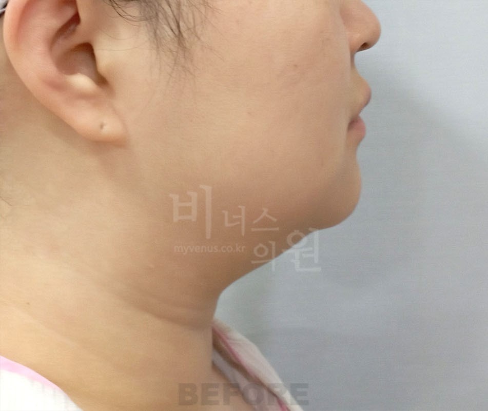 얼굴 하부 전후사진 수술 전 측면, 화면 오른쪽을 향함 (2025년 촬영, 부천 비너스의원)