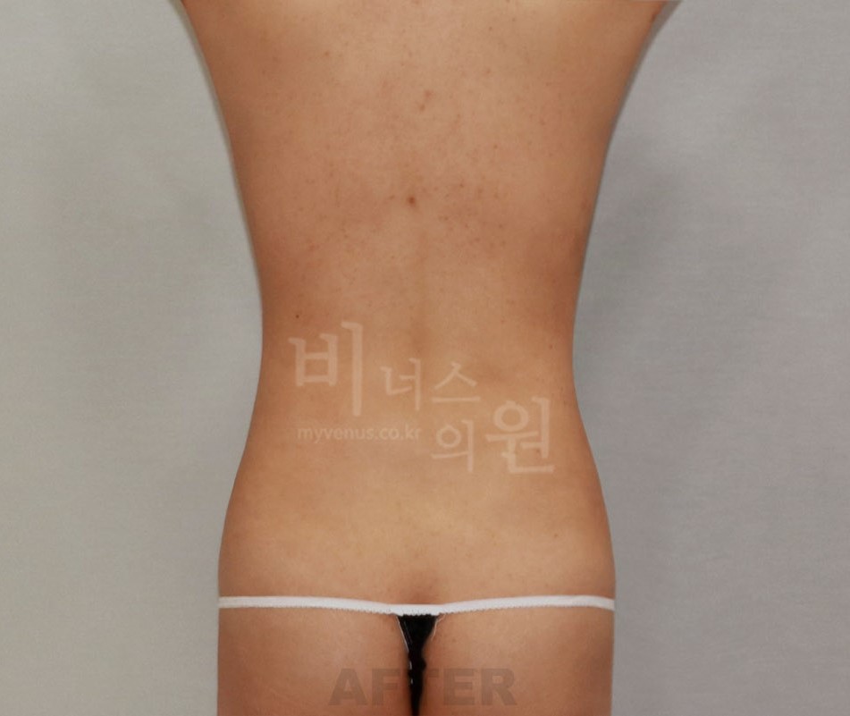 복부 지방흡입 수술 후 후면