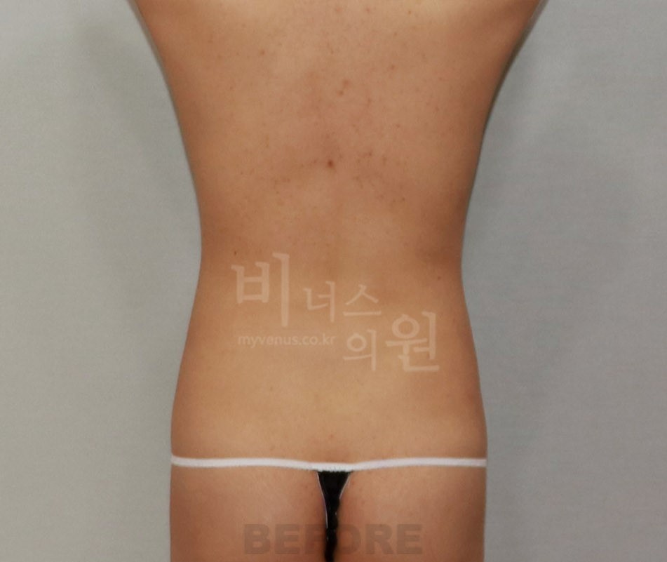 복부 지방흡입 수술 전 후면