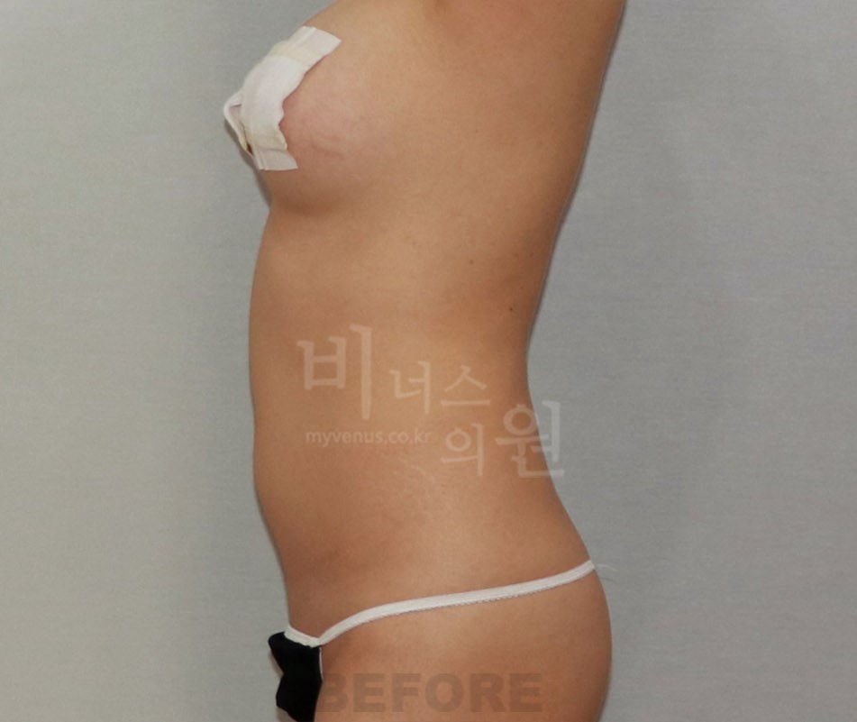 복부 지방흡입 수술 전 측면