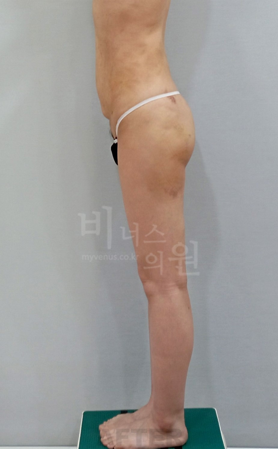 엉덩이 지방흡입 수술 후 좌측면 2023년 촬영