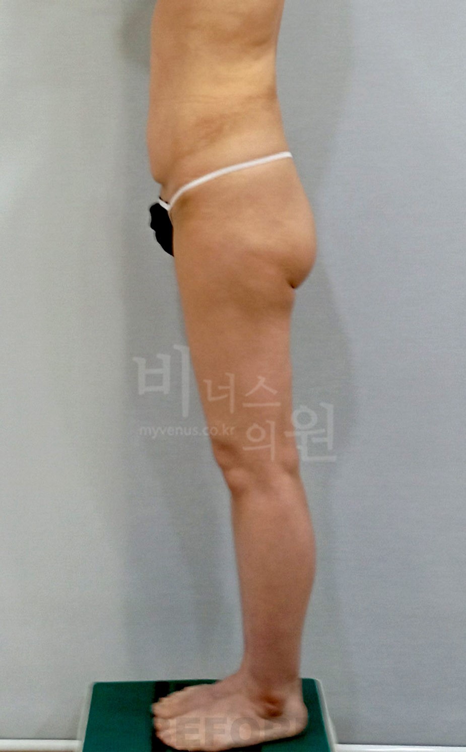 엉덩이 지방흡입 수술 전 좌측면 2023년 촬영