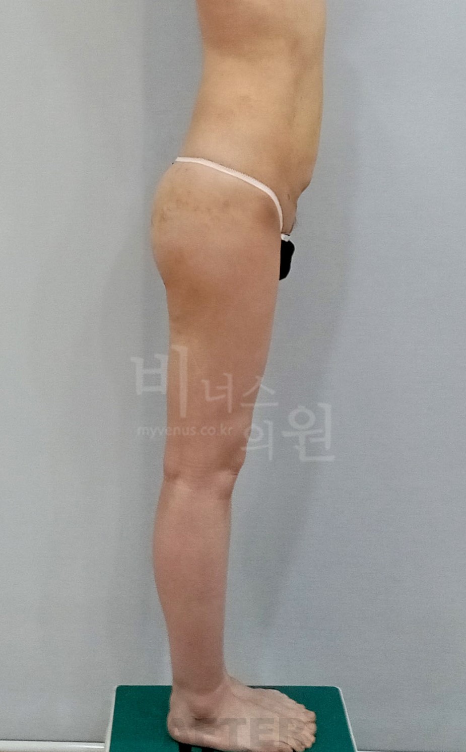 엉덩이 지방흡입 수술 후 우측면 2023년 촬영