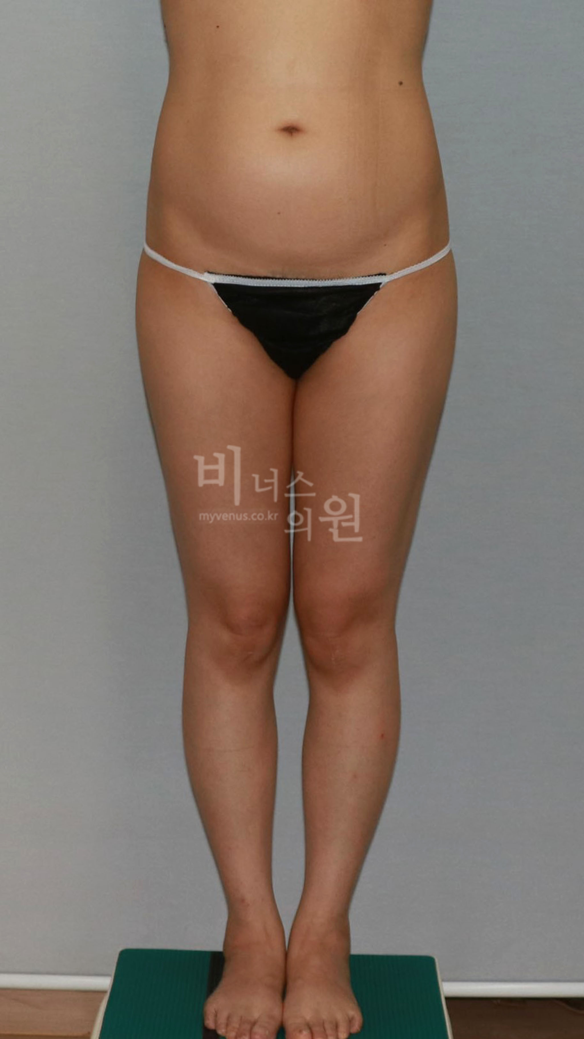 엉덩이 지방흡입 수술 후 정면 2018년 촬영