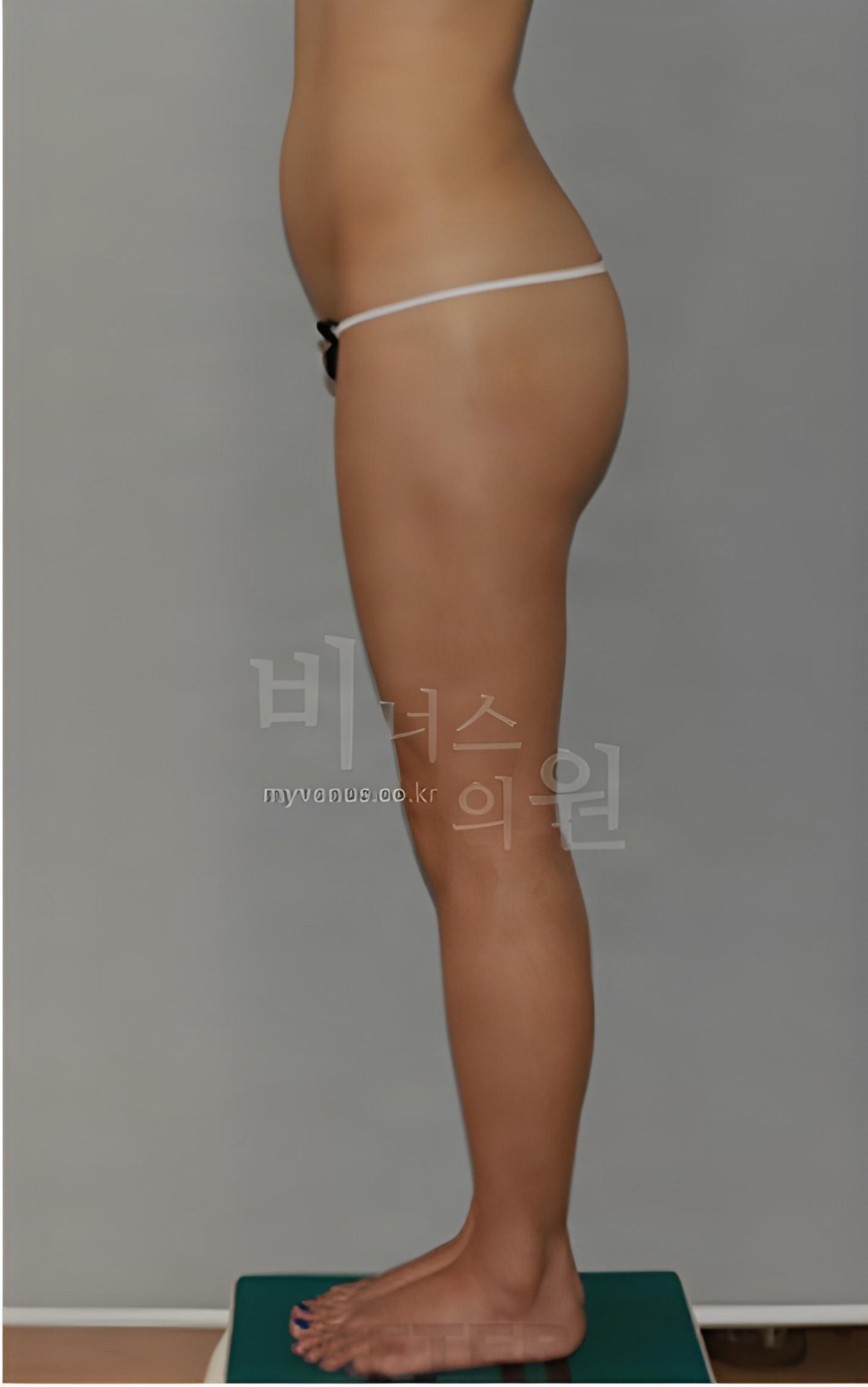 엉덩이 지방흡입 측면 수술 후 (2023년 촬영)