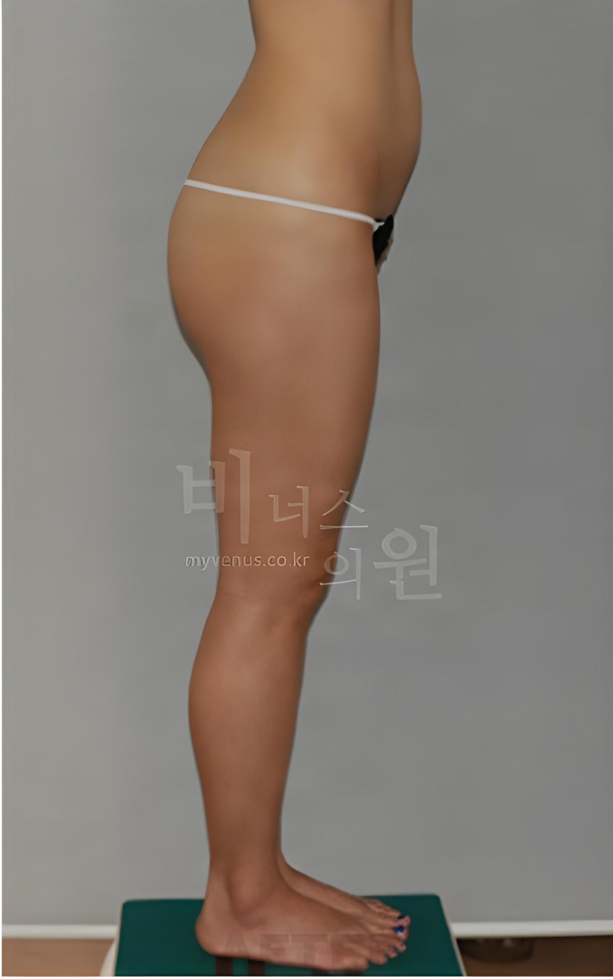 엉덩이 지방흡입 반대쪽 측면 수술 후 (2023년 촬영)