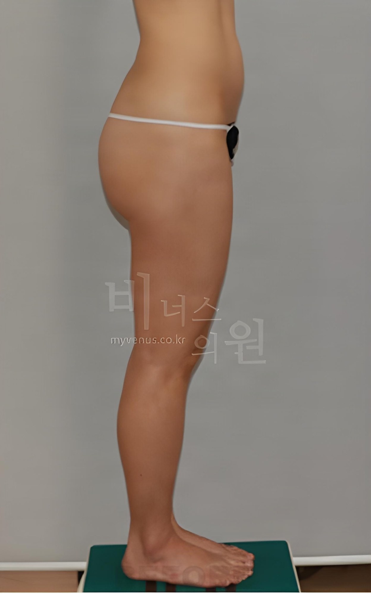 엉덩이 지방흡입 반대쪽 측면 수술 전 (2023년 촬영)