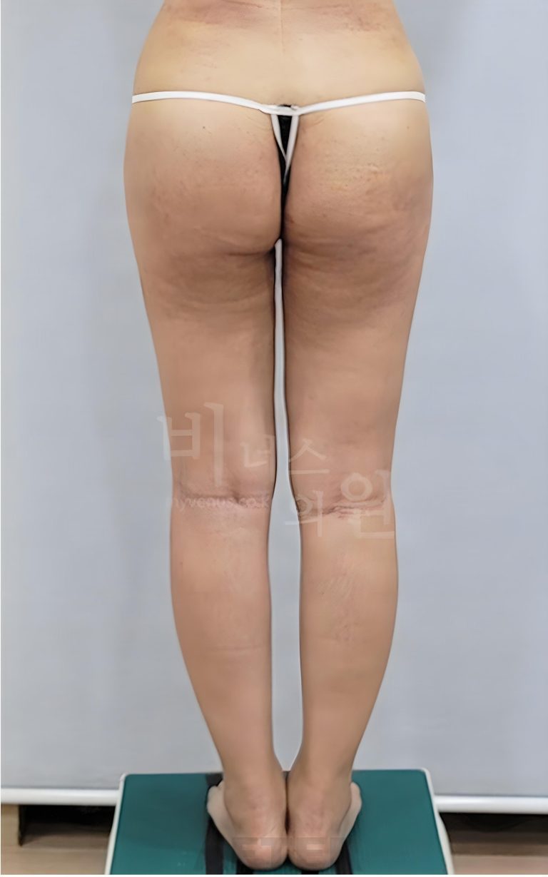 엉덩이처짐 지방흡입, ‘어디까지 하느냐’가 견적을 좌우합니다 — 하방선·승마살·허벅지 이력으로 따져 보는 범위 선택 가이드