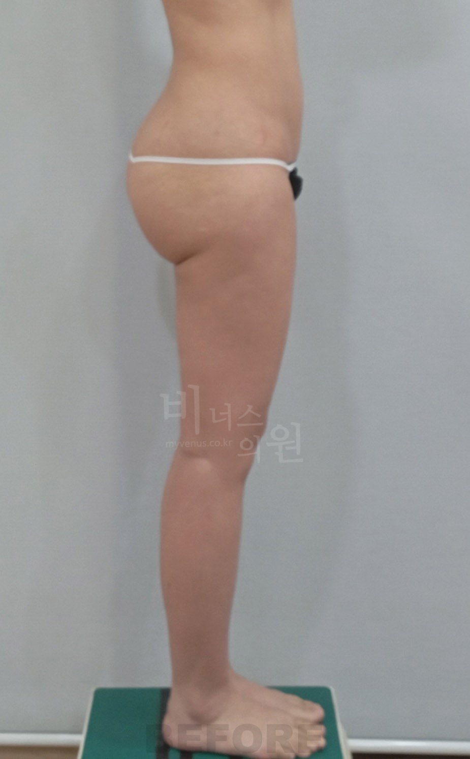 허벅지·엉덩이 수술 사례 측면 2 사진 (수술 전)