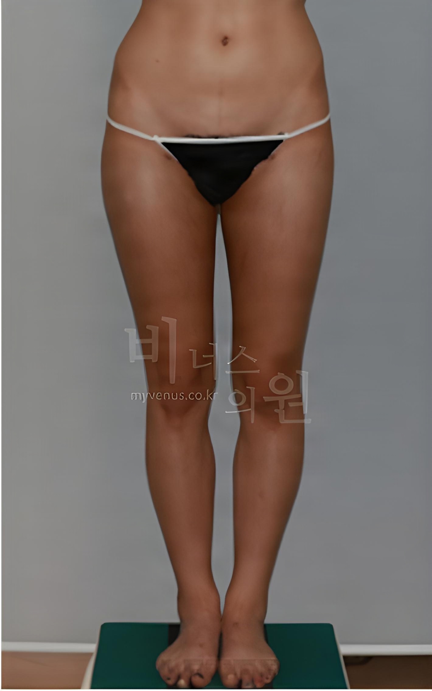 허벅지 원통형 지방흡입 수술 후 정면 사진 (2022년 촬영, 부천 비너스의원)