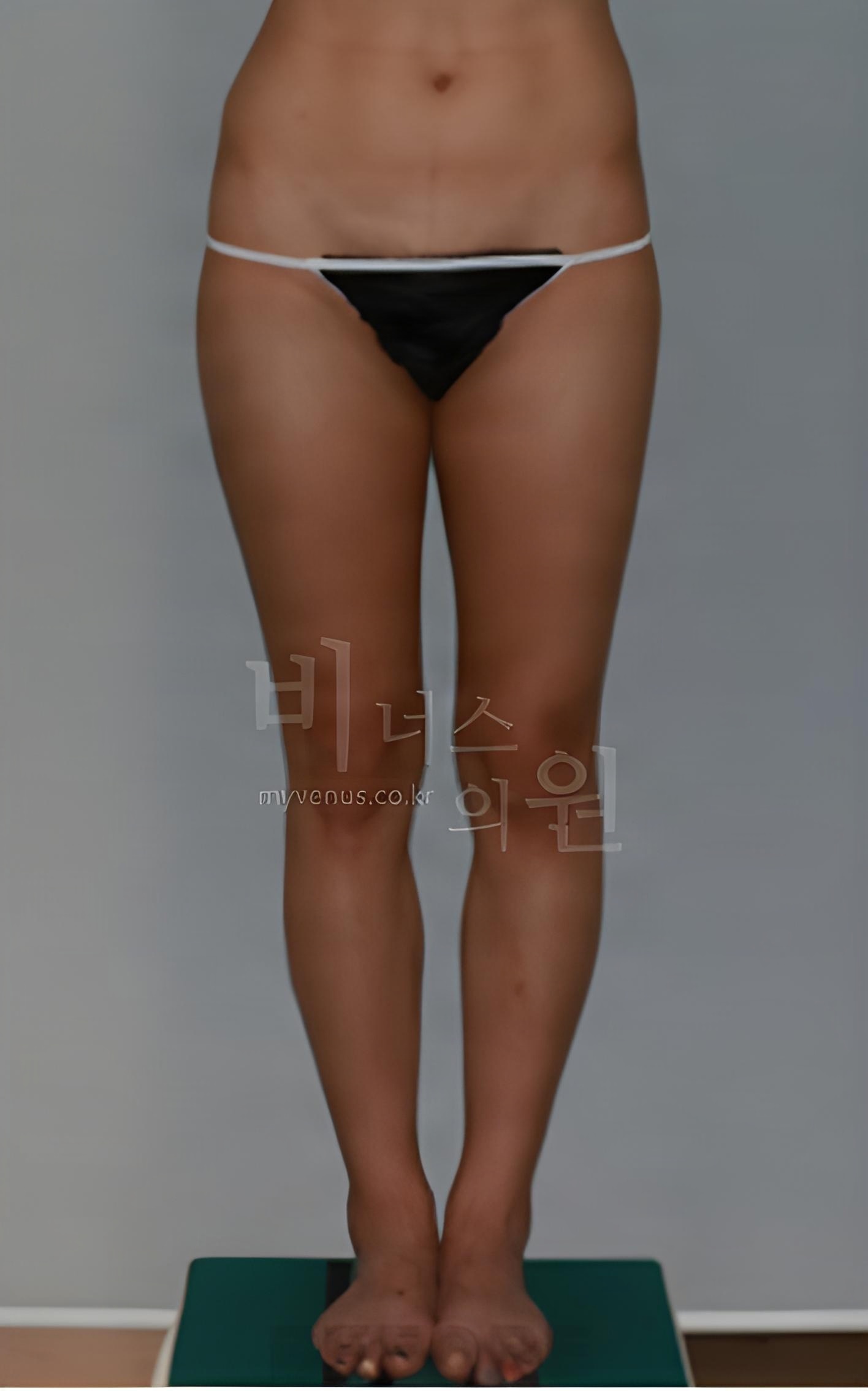 허벅지 원통형 지방흡입 수술 전 정면 사진 (2022년 촬영, 부천 비너스의원)