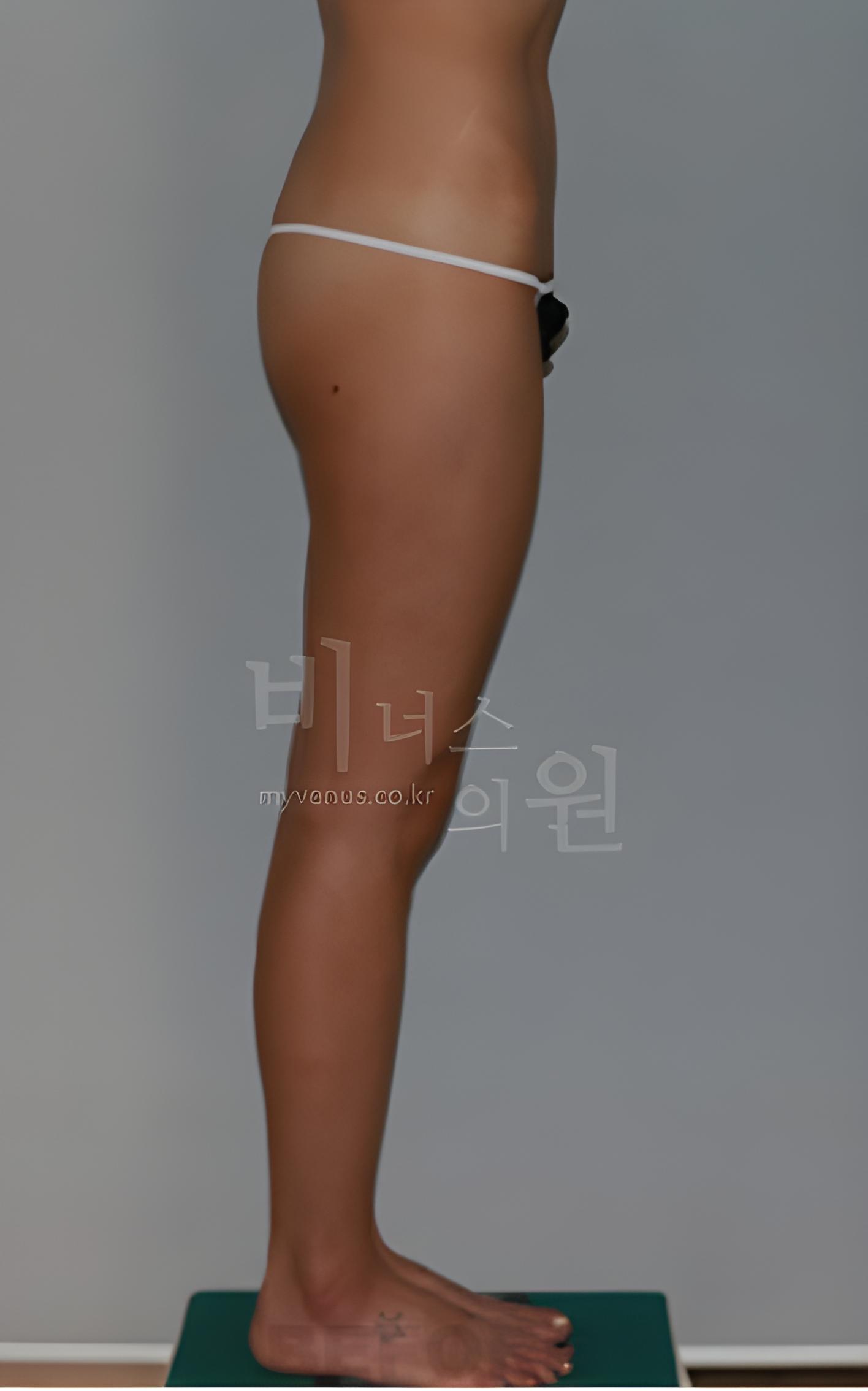 허벅지 원통형 지방흡입 수술 전 측면 사진 (2022년 촬영, 부천 비너스의원)