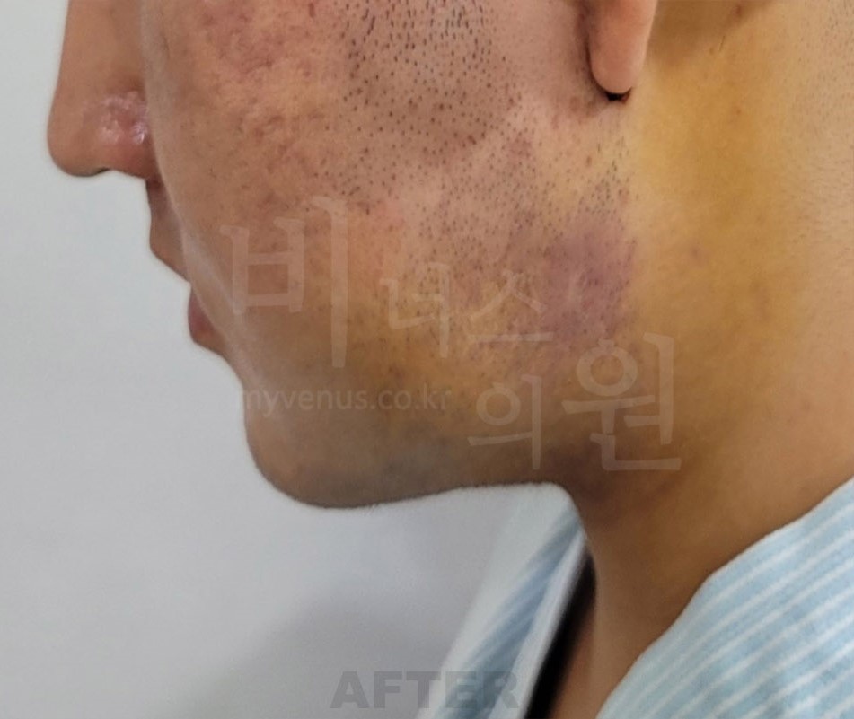 이중턱·턱라인 지방흡입 수술 후 좌측 비스듬한 측면