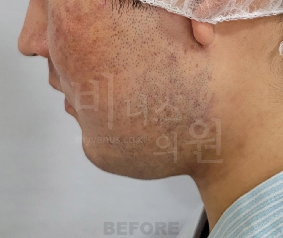 이중턱·턱라인 지방흡입 수술 전 좌측 비스듬한 측면