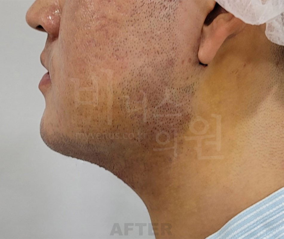 이중턱·턱라인 지방흡입 수술 후 좌측 측면