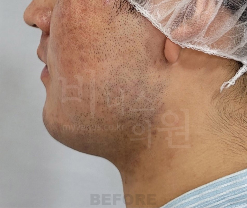 이중턱·턱라인 지방흡입 수술 전 좌측 측면
