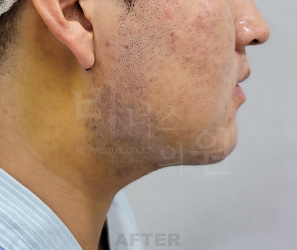 이중턱·턱라인 지방흡입 수술 후 우측 측면