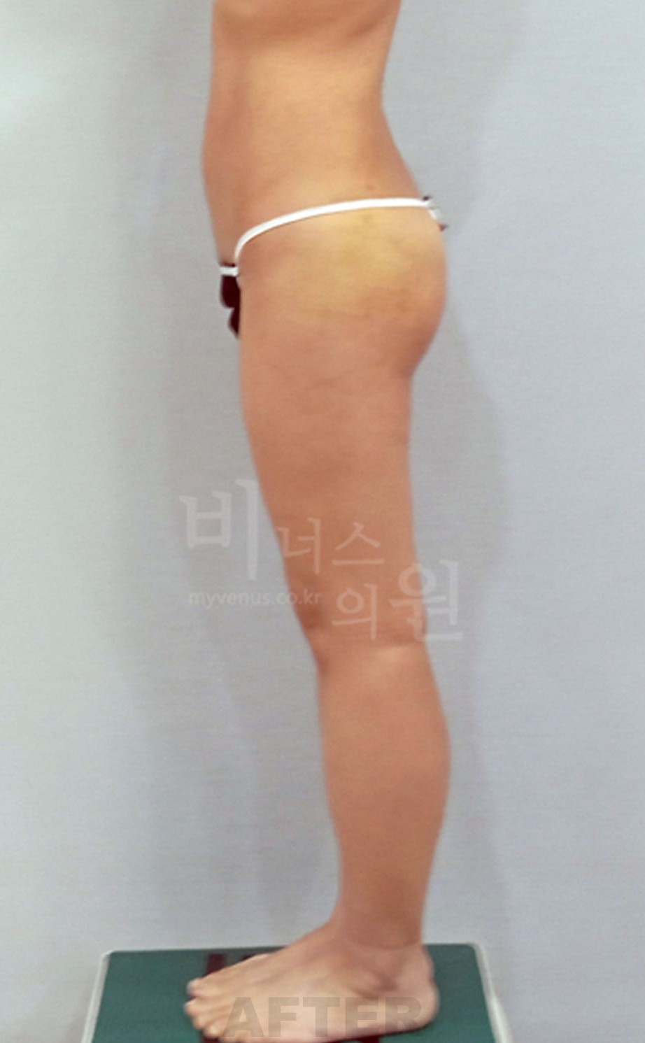 수술 후 측면 ① 사진