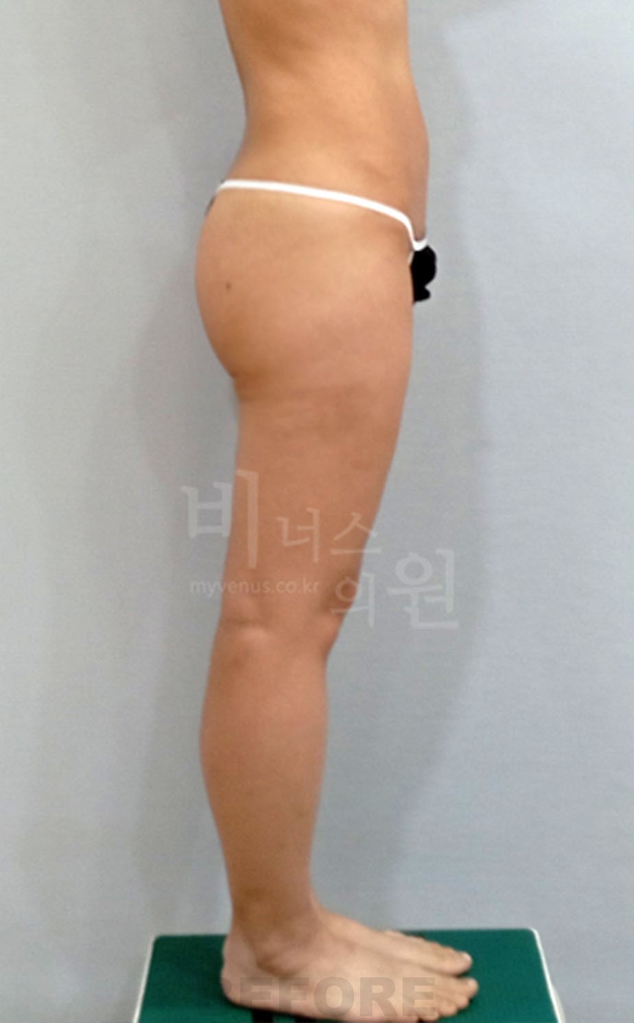 수술 전 측면 ② 사진